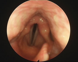 vocal folds - a sad sigh