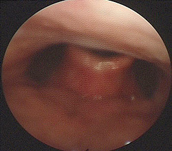 vocal folds - angry growl